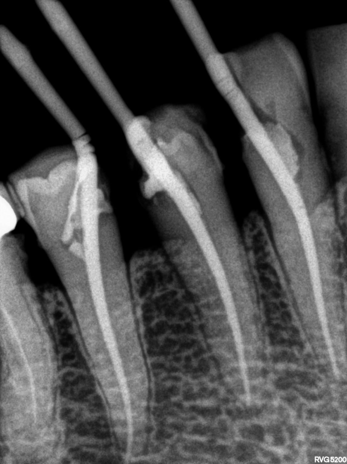 Dental X-ray